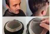Non surgical human hair treatment available hair patch wigs